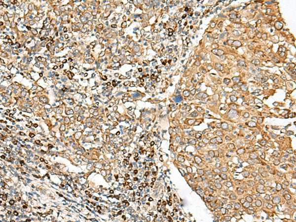 Immunohistochemistry of paraffin-embedded Human cervical cancer tissue using STT3A Polyclonal Antibody at dilution of 1:70(×200)