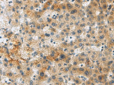Immunohistochemistry of paraffin-embedded Human liver cancer tissue using PLIN4 Polyclonal Antibody at dilution of 1:50(×200)