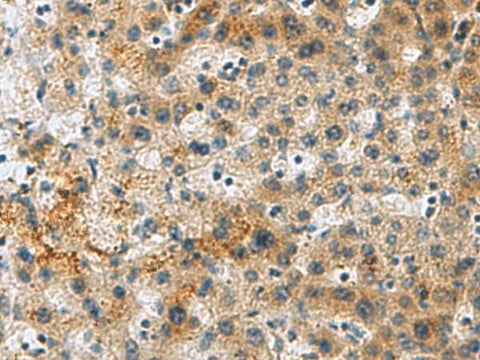 Immunohistochemistry of paraffin-embedded Human liver cancer tissue using PLIN4 Polyclonal Antibody at dilution of 1:50(×200)