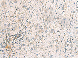 Immunohistochemistry of paraffin-embedded Human liver cancer tissue using SUSD3 Polyclonal Antibody at dilution of 1:95(×200)