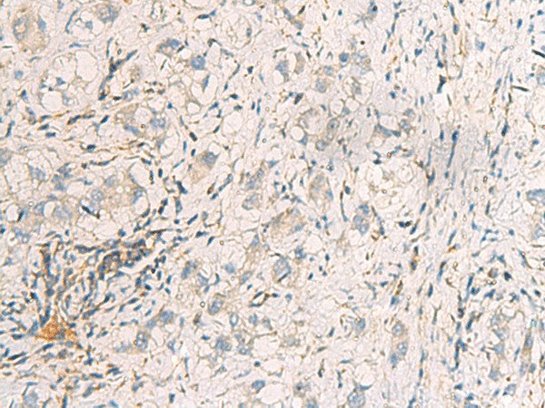 Immunohistochemistry of paraffin-embedded Human liver cancer tissue using SUSD3 Polyclonal Antibody at dilution of 1:95(×200)