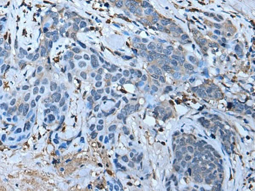 Immunohistochemistry of paraffin-embedded Human thyroid cancer tissue using F3 Polyclonal Antibody at dilution of 1:70(×200)