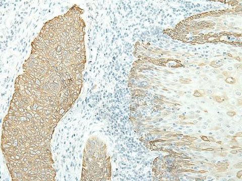 Immunohistochemistry of paraffin-embedded Human esophagus cancer tissue using ETAA1 Polyclonal Antibody at dilution of 1:40(×200)