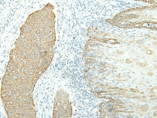 Immunohistochemistry of paraffin-embedded Human esophagus cancer tissue using ETAA1 Polyclonal Antibody at dilution of 1:40(×200)