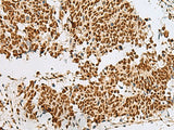 Immunohistochemistry of paraffin-embedded Human lung cancer tissue using RBM12 Polyclonal Antibody at dilution of 1:50(×200)