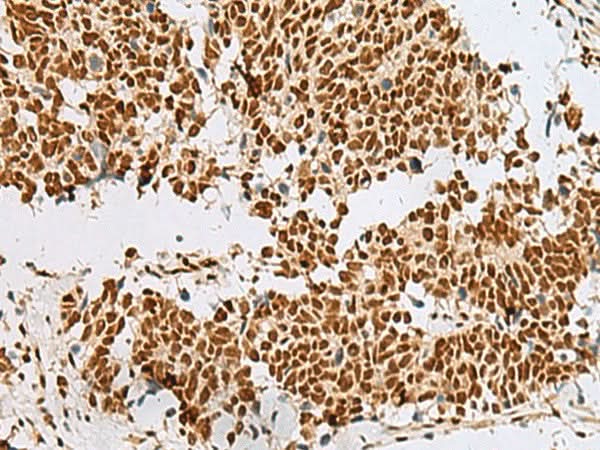 Immunohistochemistry of paraffin-embedded Human lung cancer tissue using RBM12 Polyclonal Antibody at dilution of 1:50(×200)