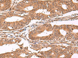 Immunohistochemistry of paraffin-embedded Human colorectal cancer tissue using IST1 Polyclonal Antibody at dilution of 1:40(×200)