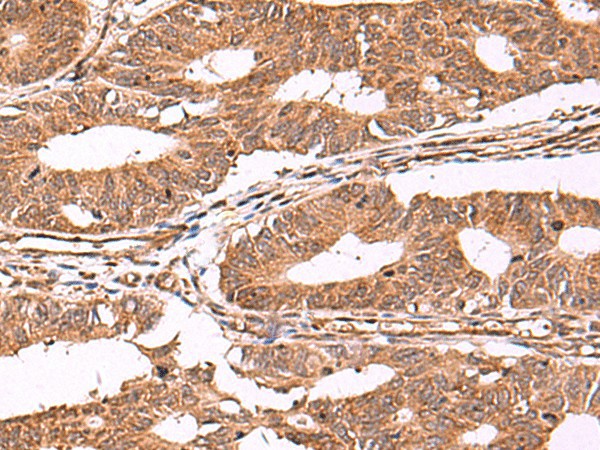 Immunohistochemistry of paraffin-embedded Human colorectal cancer tissue using IST1 Polyclonal Antibody at dilution of 1:40(×200)