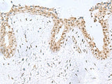 Immunohistochemistry of paraffin-embedded Human breast cancer tissue using KDM2B Polyclonal Antibody at dilution of 1:50(×200)