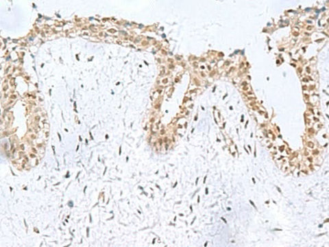 Immunohistochemistry of paraffin-embedded Human breast cancer tissue using KDM2B Polyclonal Antibody at dilution of 1:50(×200)
