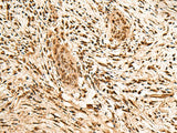 Immunohistochemistry of paraffin-embedded Human esophagus cancer tissue using PPM1G Polyclonal Antibody at dilution of 1:40(×200)