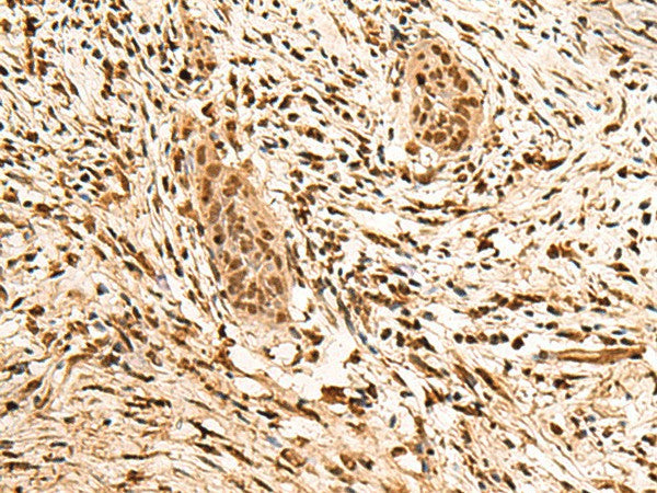 Immunohistochemistry of paraffin-embedded Human esophagus cancer tissue using PPM1G Polyclonal Antibody at dilution of 1:40(×200)