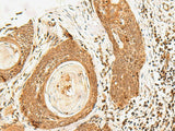 Immunohistochemistry of paraffin-embedded Human esophagus cancer tissue using POLH Polyclonal Antibody at dilution of 1:60(×200)