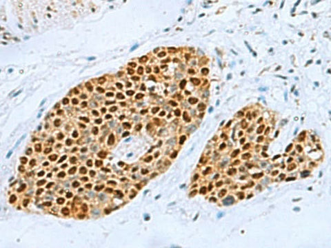Immunohistochemistry of paraffin-embedded Human esophagus cancer tissue using TFAP4 Polyclonal Antibody at dilution of 1:70(×200)