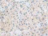 Immunohistochemistry of paraffin-embedded Human liver cancer tissue using ZNF35 Polyclonal Antibody at dilution of 1:40(×200)