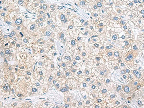 Immunohistochemistry of paraffin-embedded Human liver cancer tissue using ZNF35 Polyclonal Antibody at dilution of 1:40(×200)