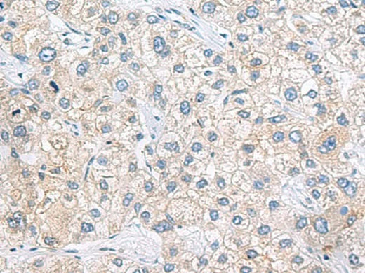 Immunohistochemistry of paraffin-embedded Human liver cancer tissue using ZNF35 Polyclonal Antibody at dilution of 1:40(×200)