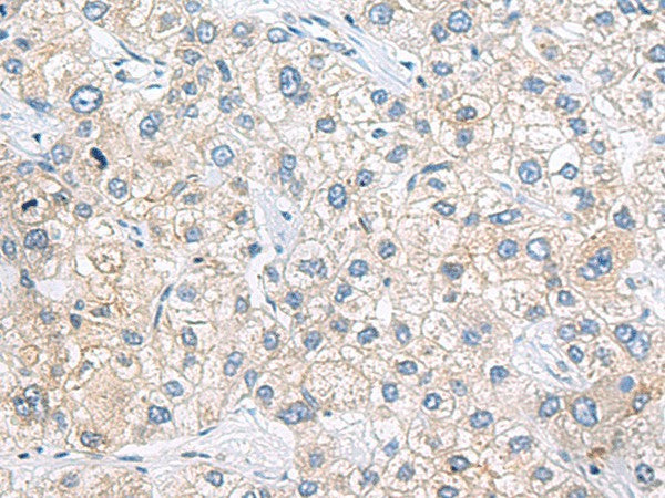 Immunohistochemistry of paraffin-embedded Human liver cancer tissue using ZNF35 Polyclonal Antibody at dilution of 1:40(×200)