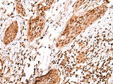 Immunohistochemistry of paraffin-embedded Human esophagus cancer tissue using AK9 Polyclonal Antibody at dilution of 1:60(×200)