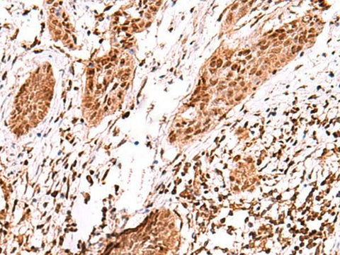 Immunohistochemistry of paraffin-embedded Human esophagus cancer tissue using AK9 Polyclonal Antibody at dilution of 1:60(×200)