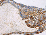 Immunohistochemistry of paraffin-embedded Human thyroid cancer tissue using GNAI1 Polyclonal Antibody at dilution of 1:100(×200)