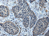 Immunohistochemistry of paraffin-embedded Human cervical cancer tissue using ULK4 Polyclonal Antibody at dilution of 1:75(×200)