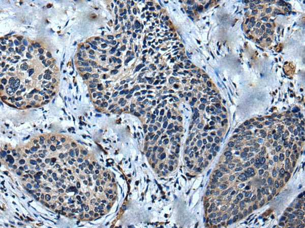 Immunohistochemistry of paraffin-embedded Human cervical cancer tissue using ULK4 Polyclonal Antibody at dilution of 1:75(×200)