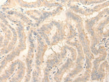 Immunohistochemistry of paraffin-embedded Human thyroid cancer tissue using ERP27 Polyclonal Antibody at dilution of 1:25(×200)