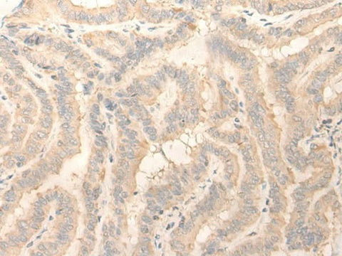 Immunohistochemistry of paraffin-embedded Human thyroid cancer tissue using ERP27 Polyclonal Antibody at dilution of 1:25(×200)