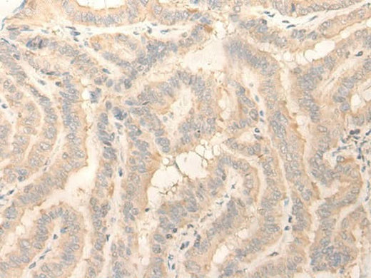 Immunohistochemistry of paraffin-embedded Human thyroid cancer tissue using ERP27 Polyclonal Antibody at dilution of 1:25(×200)