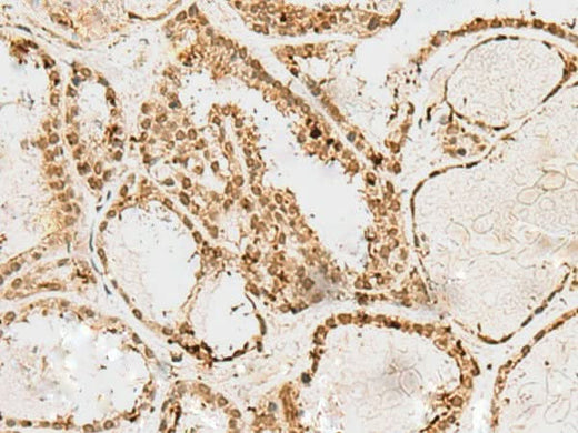Immunohistochemistry of paraffin-embedded Human thyroid cancer tissue using SNAPC1 Polyclonal Antibody at dilution of 1:60(×200)