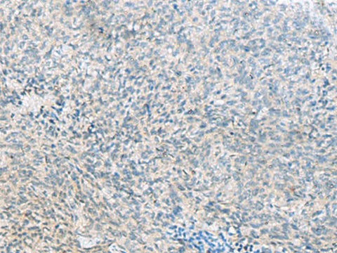 Immunohistochemistry of paraffin-embedded Human cervical cancer tissue using C1orf112 Polyclonal Antibody at dilution of 1:55(×200)