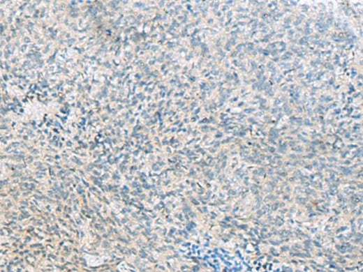 Immunohistochemistry of paraffin-embedded Human cervical cancer tissue using C1orf112 Polyclonal Antibody at dilution of 1:55(×200)