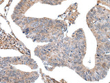 Immunohistochemistry of paraffin-embedded Human colorectal cancer tissue using USP37 Polyclonal Antibody at dilution of 1:45(×200)