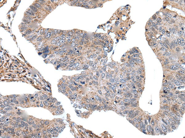 Immunohistochemistry of paraffin-embedded Human colorectal cancer tissue using USP37 Polyclonal Antibody at dilution of 1:45(×200)