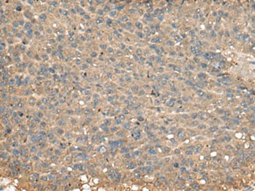 Immunohistochemistry of paraffin-embedded Human liver cancer tissue using PLA2G2A Polyclonal Antibody at dilution of 1:55(×200)