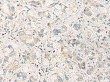 Immunohistochemistry of paraffin-embedded Human liver cancer tissue using SPSB2 Polyclonal Antibody at dilution of 1:70(×200)