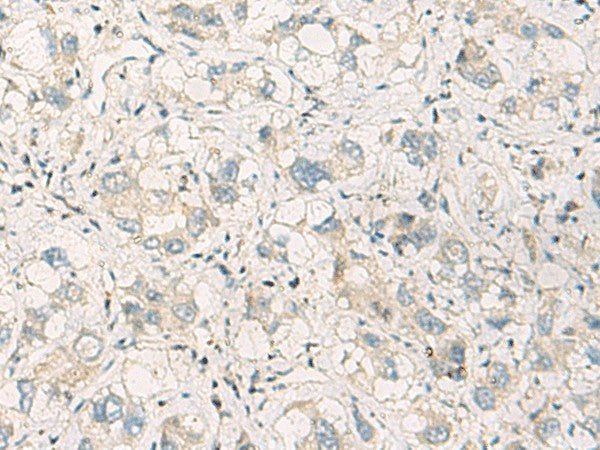 Immunohistochemistry of paraffin-embedded Human liver cancer tissue using SPSB2 Polyclonal Antibody at dilution of 1:70(×200)
