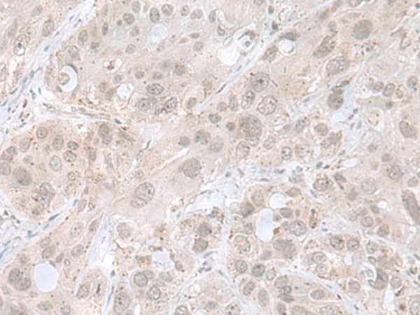 Immunohistochemistry of paraffin-embedded Human esophagus cancer tissue using THAP12 Polyclonal Antibody at dilution of 1:45(×200)