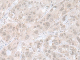 Immunohistochemistry of paraffin-embedded Human esophagus cancer tissue using THAP12 Polyclonal Antibody at dilution of 1:45(×200)