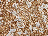 Immunohistochemistry of paraffin-embedded Human ovarian cancer tissue using HABP4 Polyclonal Antibody at dilution of 1:55(×200)