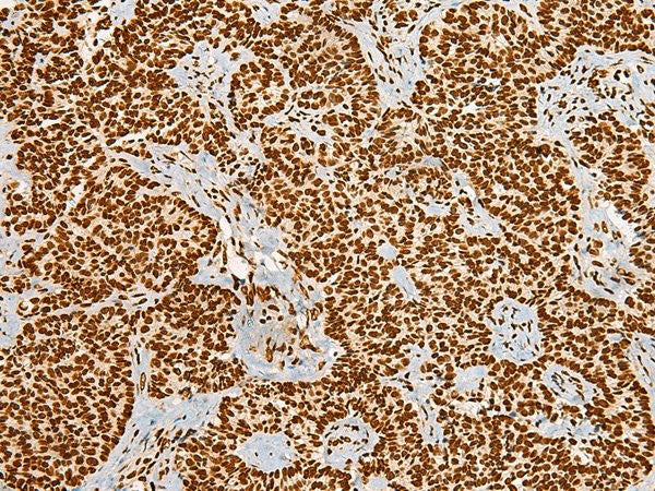 Immunohistochemistry of paraffin-embedded Human ovarian cancer tissue using HABP4 Polyclonal Antibody at dilution of 1:55(×200)
