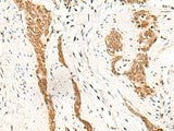 Immunohistochemistry of paraffin-embedded Human esophagus cancer tissue using HOXC13 Polyclonal Antibody at dilution of 1:60(×200)