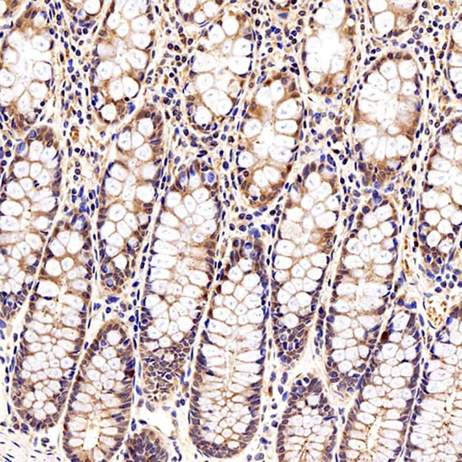 Immunohistochemistry analysis of paraffin-embedded human colon tissue using Galectin 3 Polyclonal Antibody at dilution of 1:300.