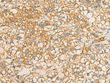 Immunohistochemistry of paraffin-embedded Human liver cancer tissue using AIMP1 Polyclonal Antibody at dilution of 1:40(×200)