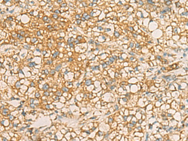Immunohistochemistry of paraffin-embedded Human liver cancer tissue using AIMP1 Polyclonal Antibody at dilution of 1:40(×200)