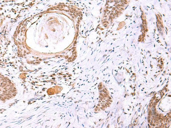 Immunohistochemistry of paraffin-embedded Human esophagus cancer tissue using ITPKC Polyclonal Antibody at dilution of 1:30(×200)