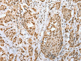 Immunohistochemistry of paraffin-embedded Human breast cancer tissue using ZNF486 Polyclonal Antibody at dilution of 1:50(×200)