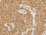Immunohistochemistry of paraffin-embedded Human ovarian cancer tissue using GRSF1 Polyclonal Antibody at dilution of 1:30(×200)