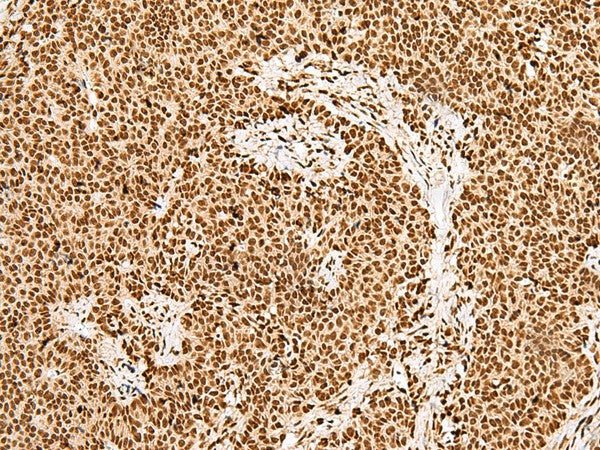 Immunohistochemistry of paraffin-embedded Human ovarian cancer tissue using GRSF1 Polyclonal Antibody at dilution of 1:30(×200)